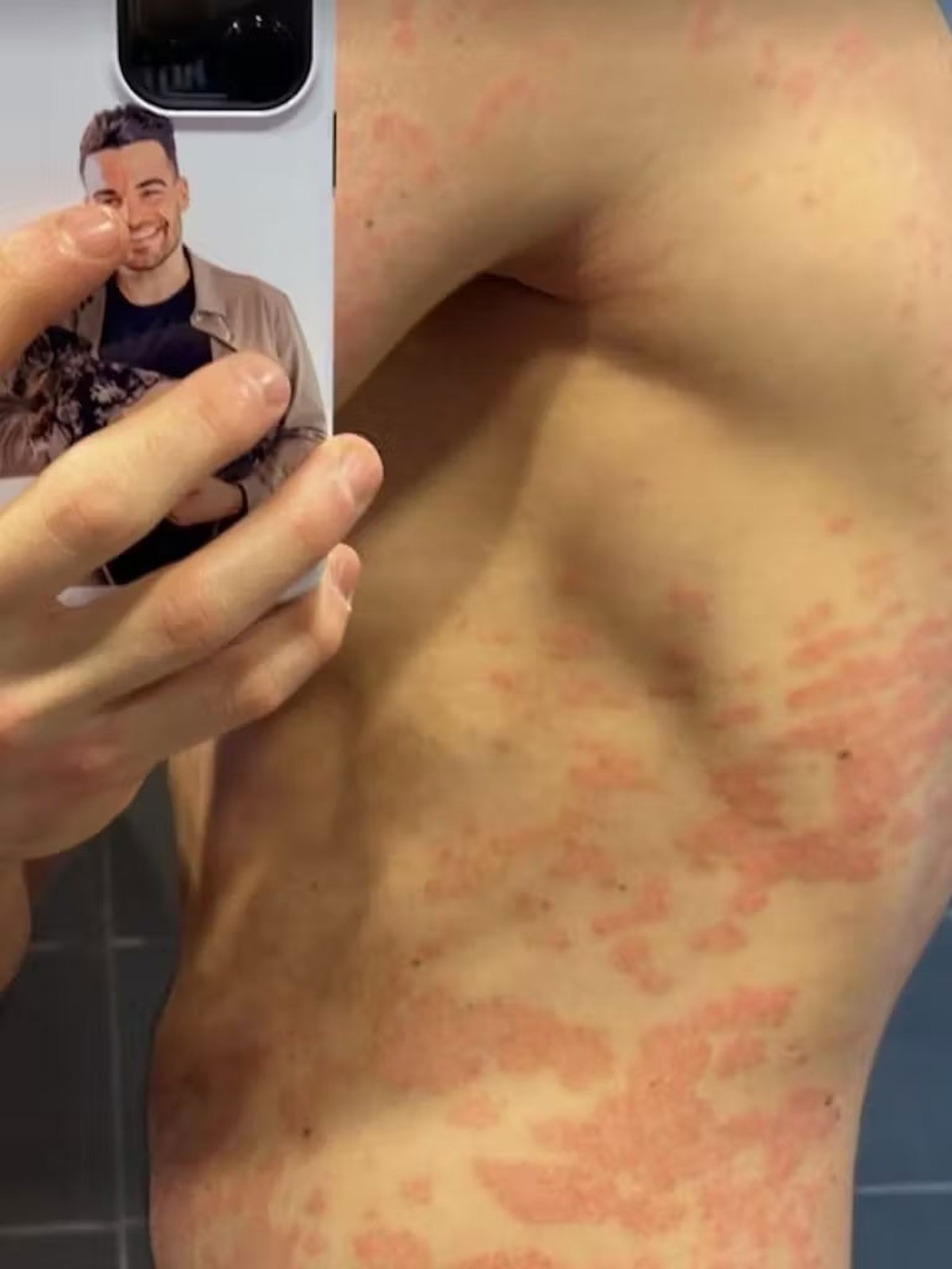 Stefano zeigt seinen nackten Oberkörper bei Instagram, die Krankheit ist deutlich sichtbar.