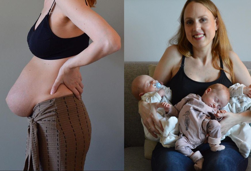 So sieht ein Bauch 4 Wochen nach einer Drillings-Geburt wirklich aus