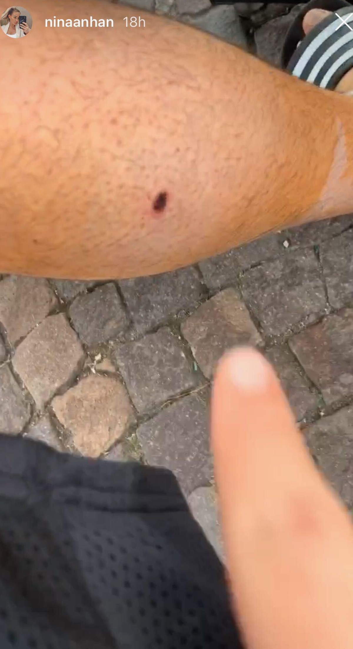Der Rapper zeigt die Seite, wo die Kugel zuerst durch das Bein ging.