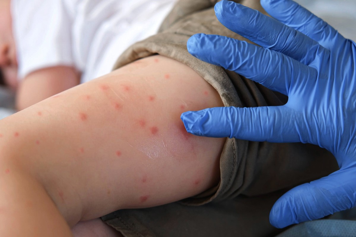 Doctor examining child with bodily red rash. Kid allergy closeup. Little baby scratches an eruption. Nurse applies special cream to atopic skin. Dermatitis, irritation, hive. Pruritus. Mosquito bites. ...