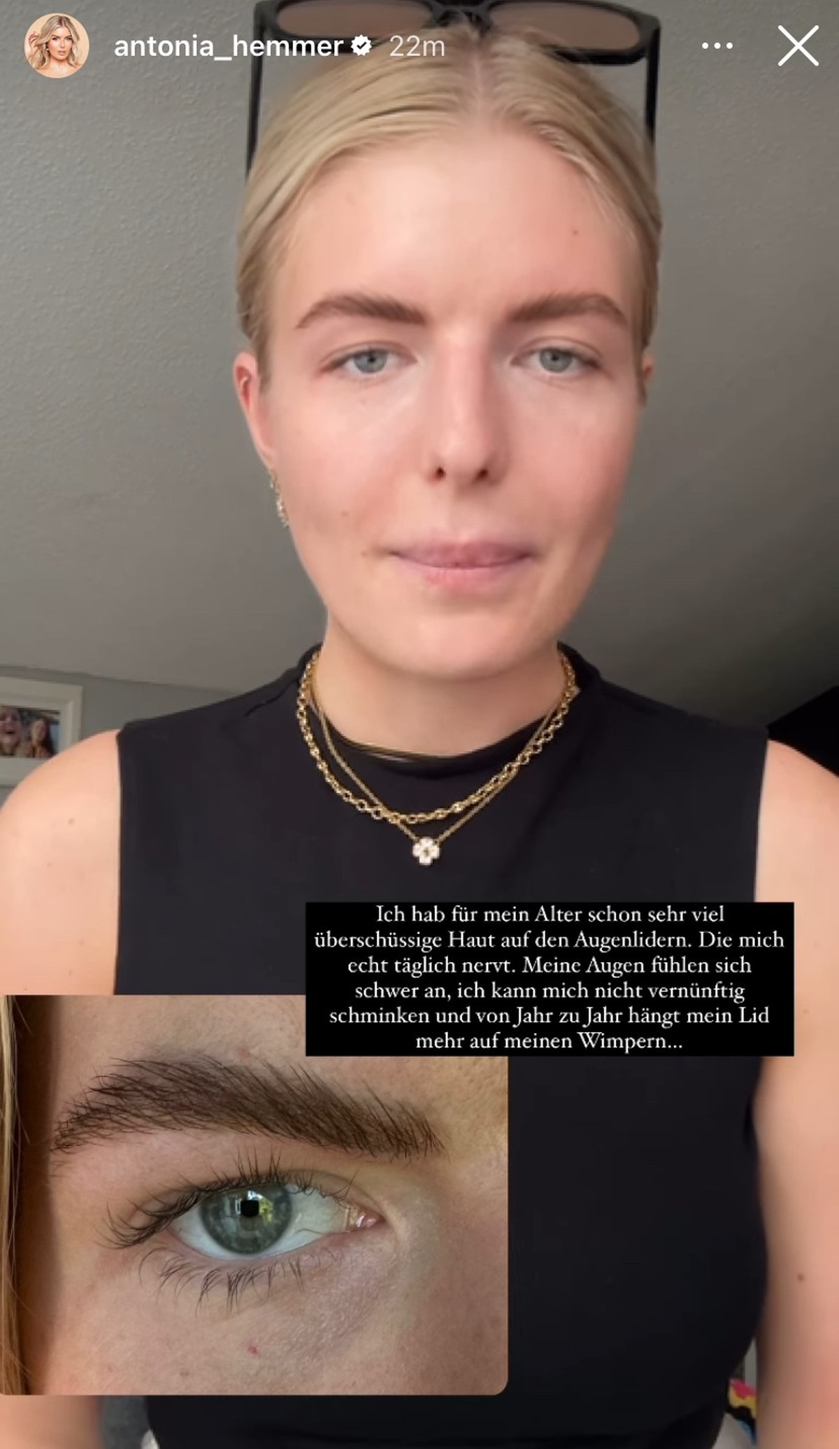 Antonia Hemmer wird einen Eingriff an ihren Augenlidern vornehmen lassen.