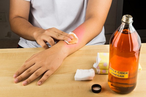 Apple cider vinegar effective natural remedy for skin itch, fungal infection, warts, bruises and burns