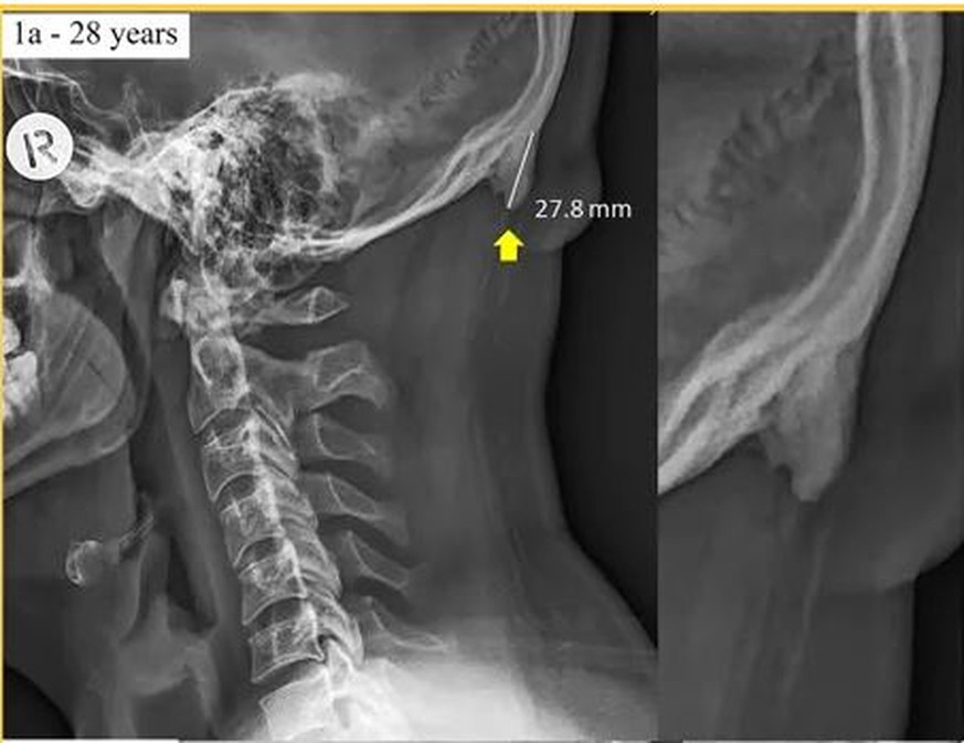 "Prominent exostosis projecting from the occipital squama more substantial and prevalent in young adult than older age groups", Scientific Reports