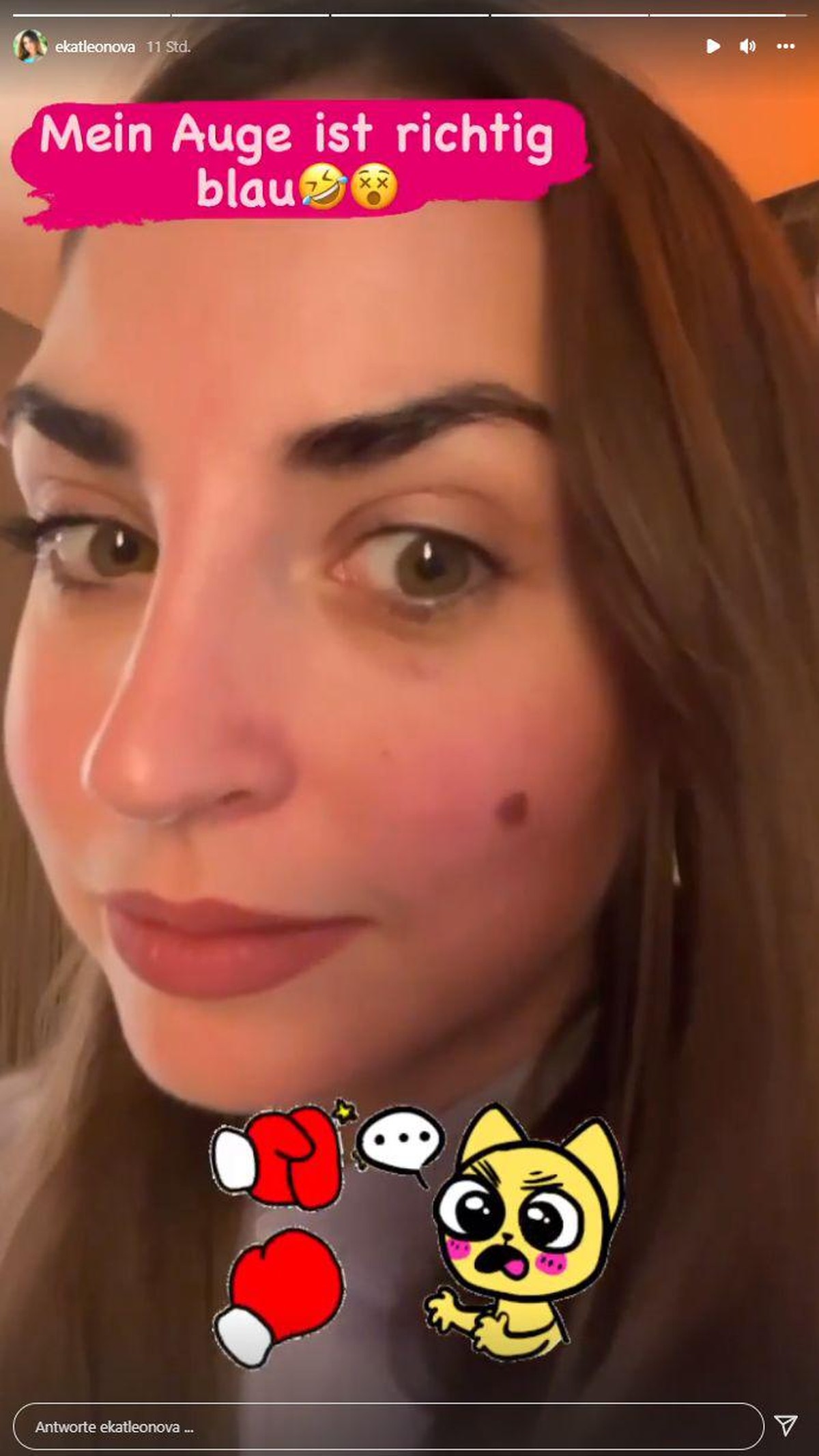 Ekat zeigt ihr blaues Auge.
