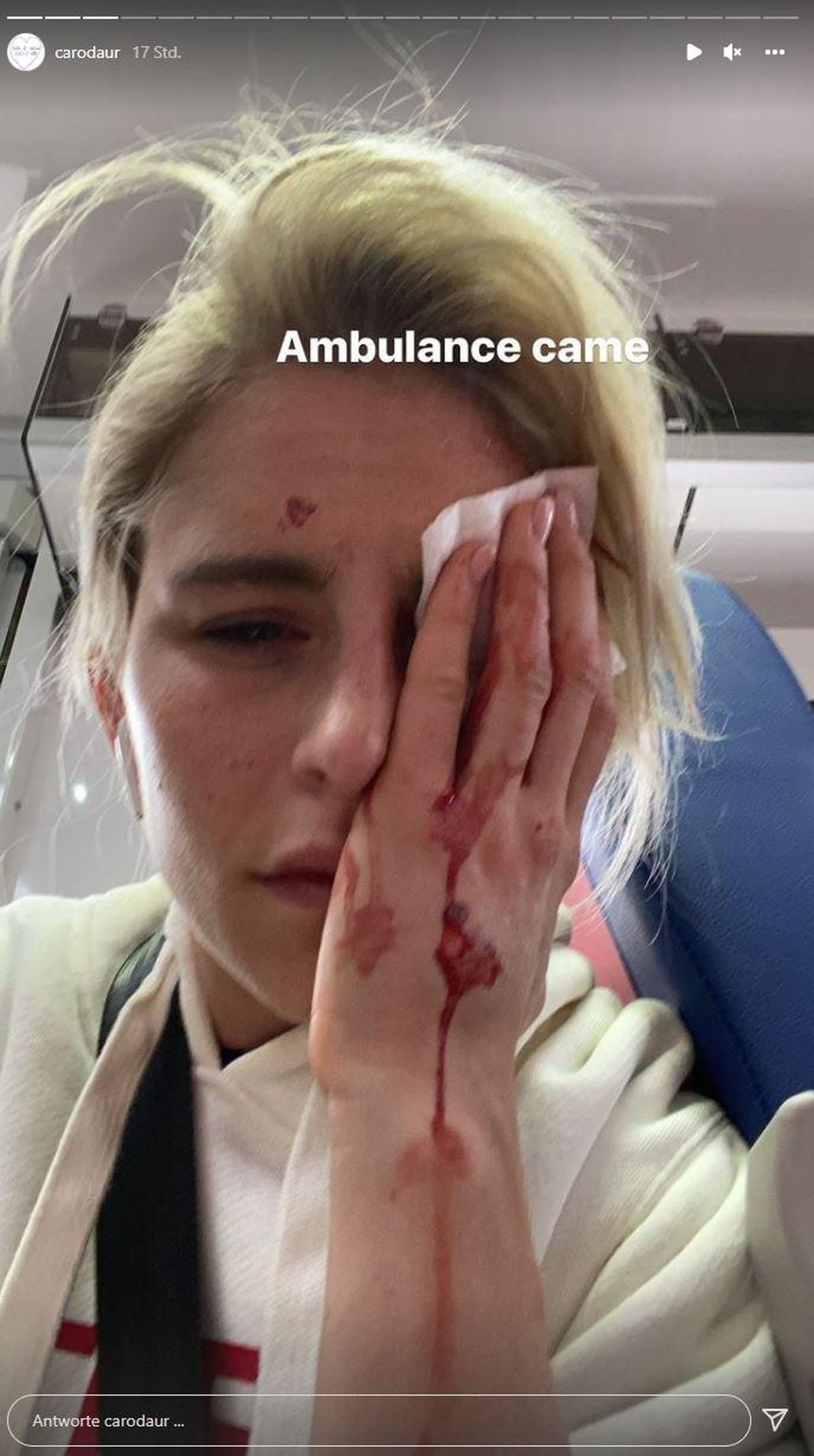 Caro Daur zeigt ihren Fans ihre Verletzung.