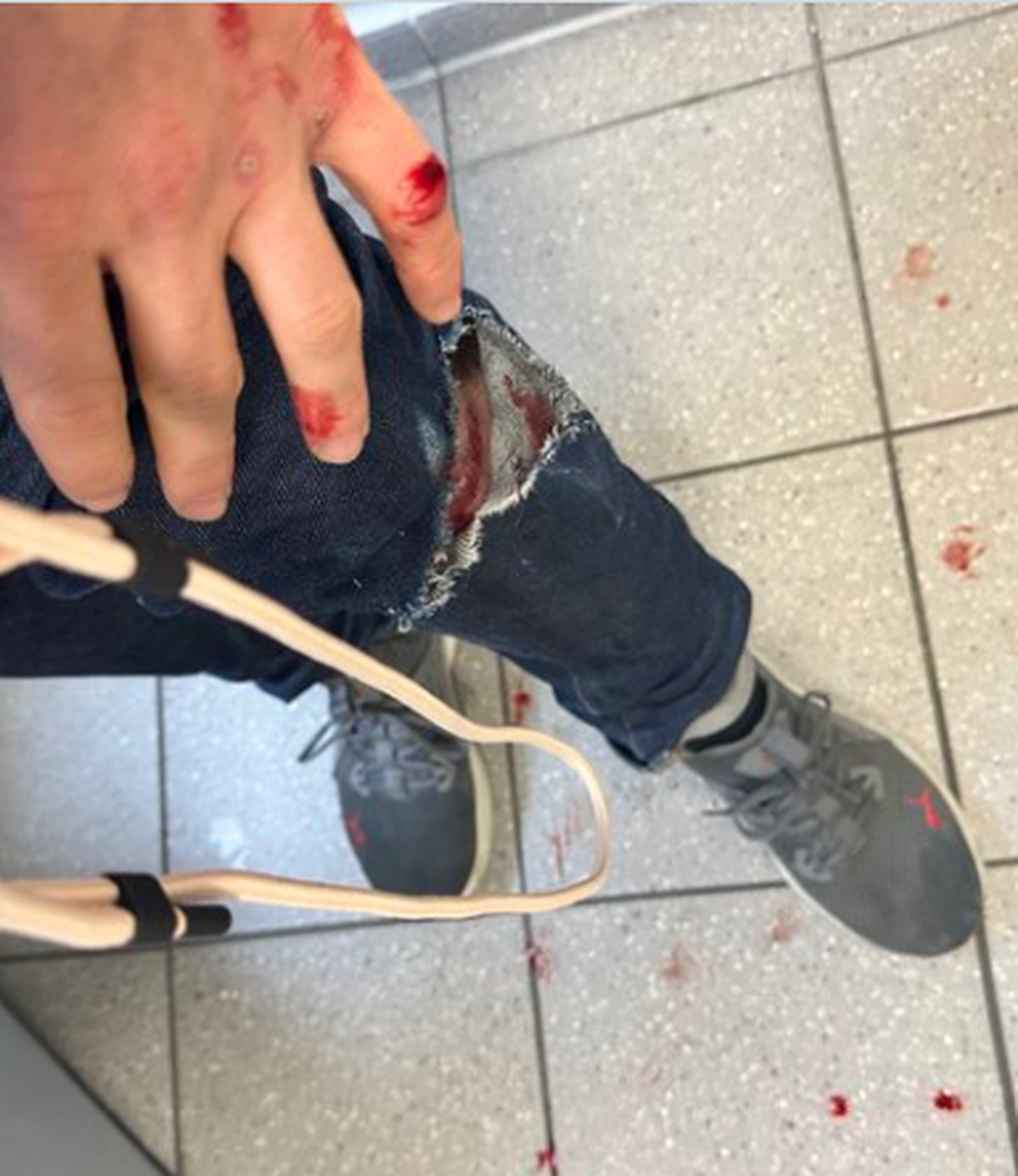 Auf Twitter teilt Shapira Fotos von seiner blutigen Hand.