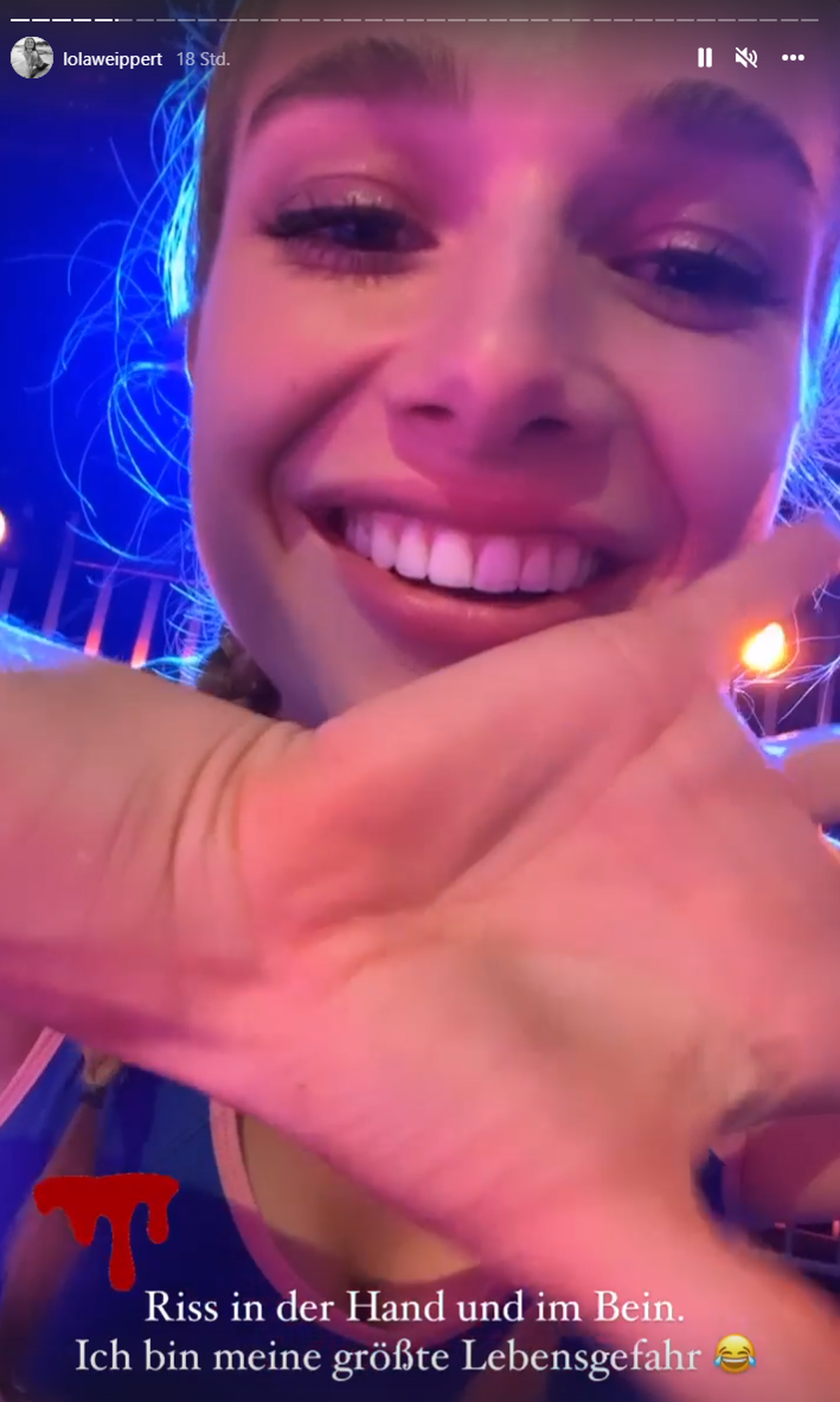 Lola Weippert zeigt ihre Wunde im Netz.