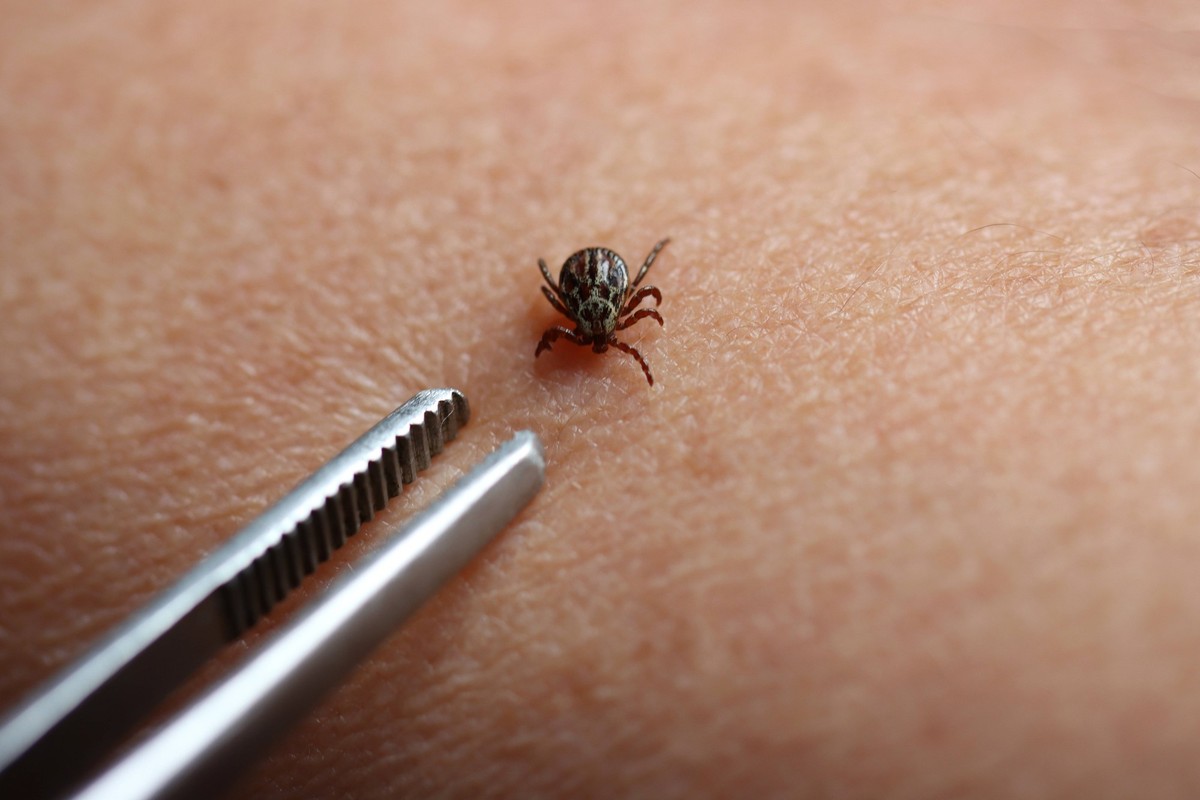 Zecke wird mit einer Pinzette entfernt *** Tick will with a Tweezers removed 1033004253
