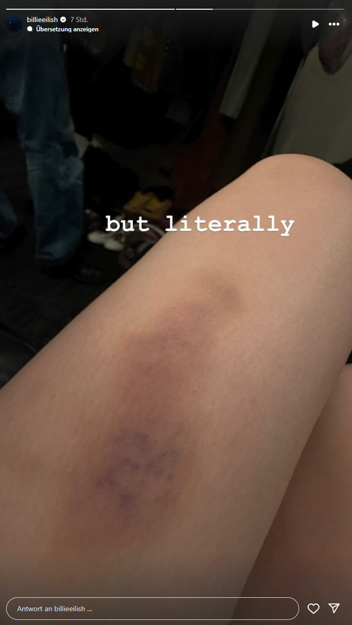 Billie Eilish präsentiert ihren Fans nach ihrem Bühnensturz ihre Verletzung.