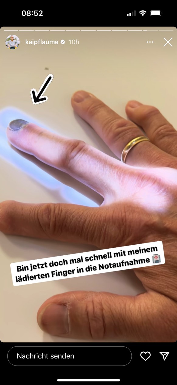 Kai Pflaume zeigt auf Instagram seinen verletzten Finger.