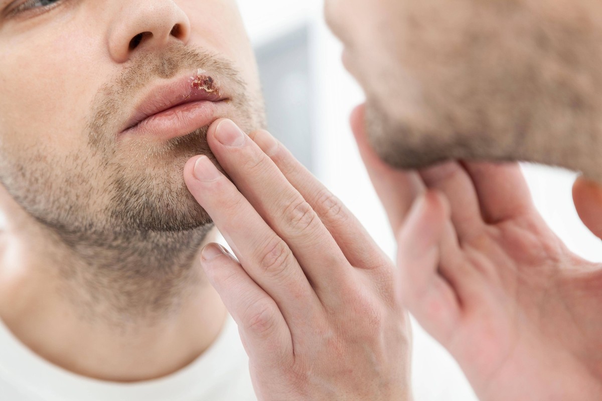 Young man suffering from herpes on his mouth ,model released, Symbolfoto PUBLICATIONxINxGERxSUIxAUTxONLY Copyright: xtommyandonex Panthermedia24276362