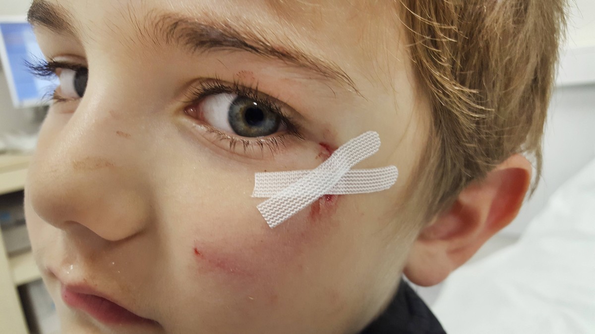 kleiner Junge mit einer wundversorgten Platzwunde im Gesicht, Portraet, Deutschland little boy with a wound cared laceration in the face, portrait, Germany BLWS434059 Copyright: xblickwinkel/fotototox ...