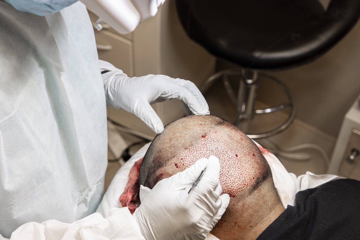 Arzt führt Haartransplantation durch. Chirurgen im Operationssaal führen eine Haartransplantation durch Doctor performing hair transplant. Surgeons in the operating room carry out hair transplant surg ...