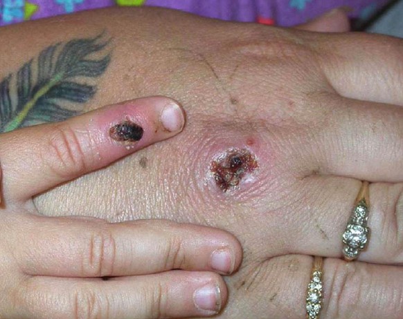 UNDATED ? JUNE 5: In this Centers for Disease Control and Prevention handout graphic, symptoms of one of the first known cases of the monkeypox virus are shown on a patient?s hand June 5, 2003. The CD ...