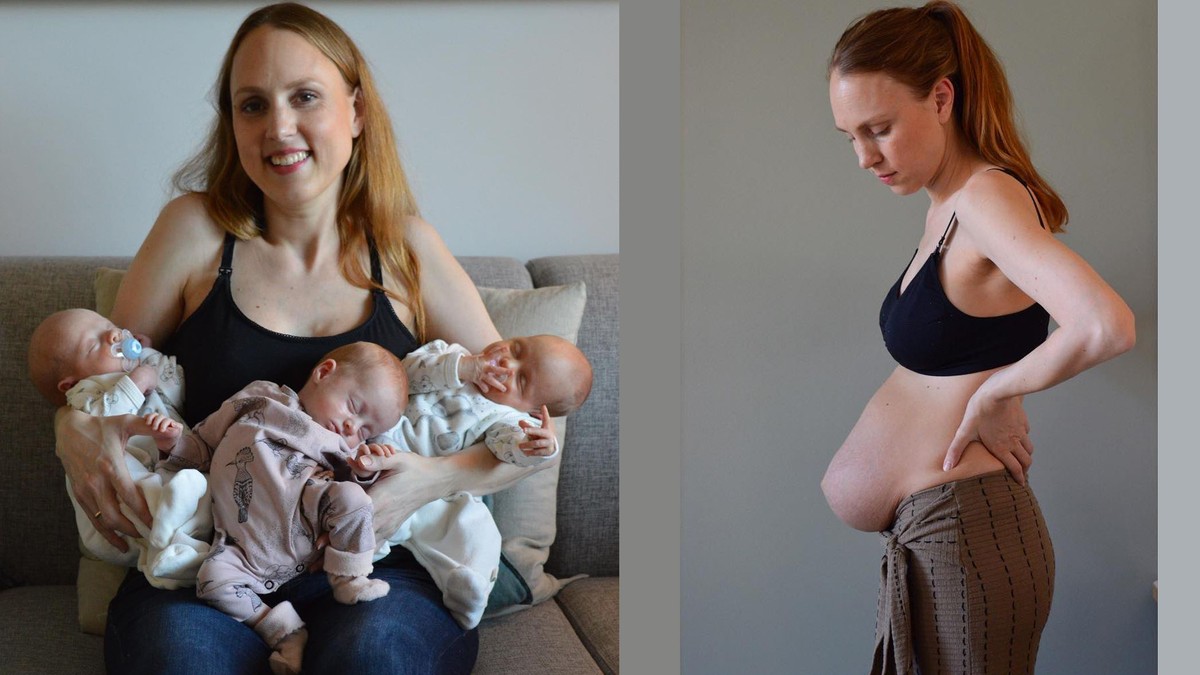Bauch nach der geburt