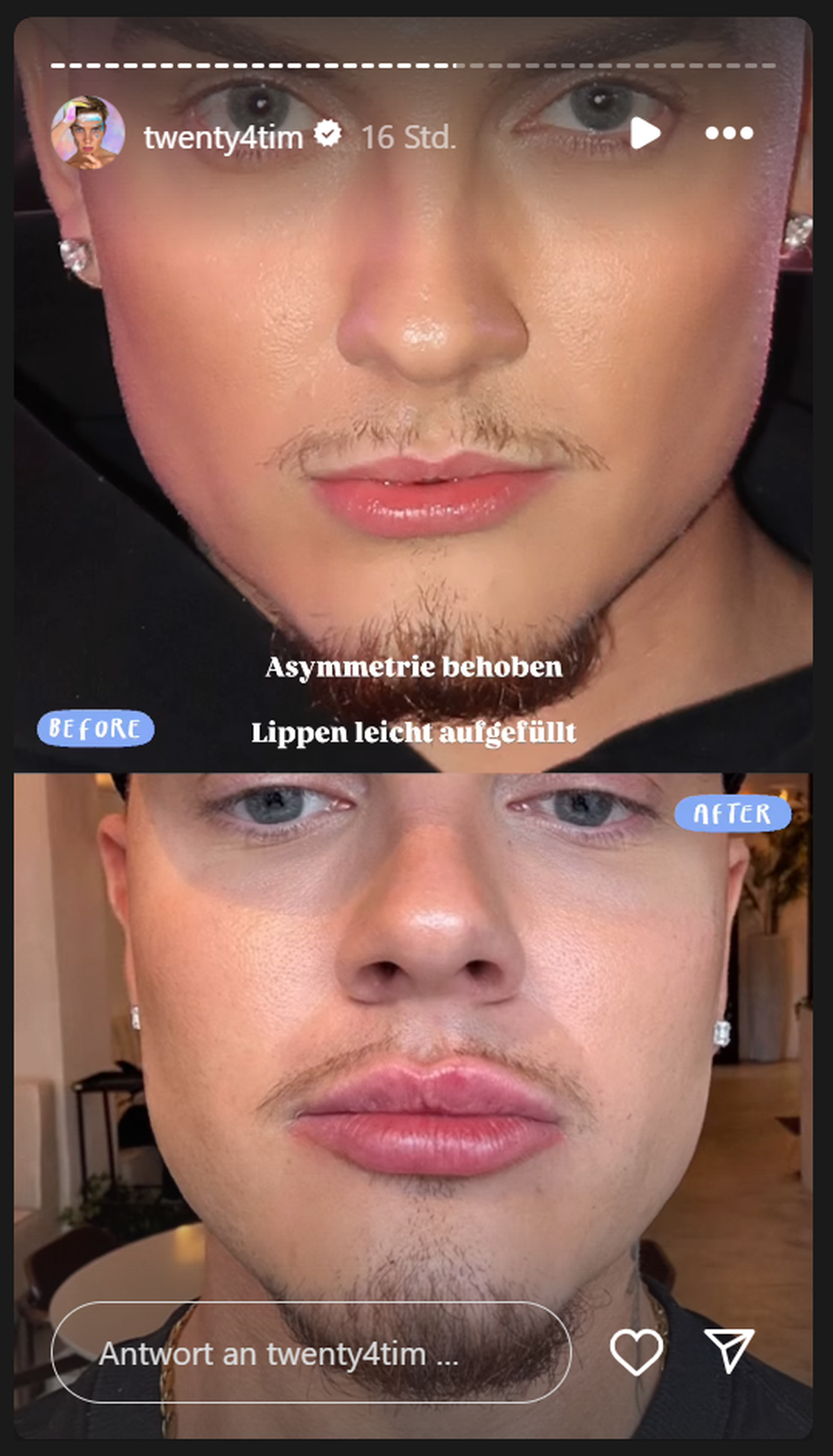 Auf Social Media hielt der Influencer das Resultat seiner Behandlung fest.
