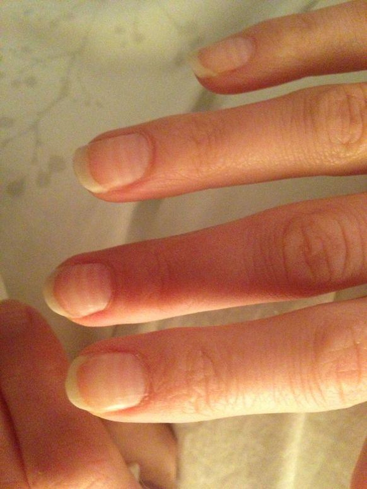 Jeder Chemozyklus hat einen Ring auf ihren Fingernägeln hinterlassen.