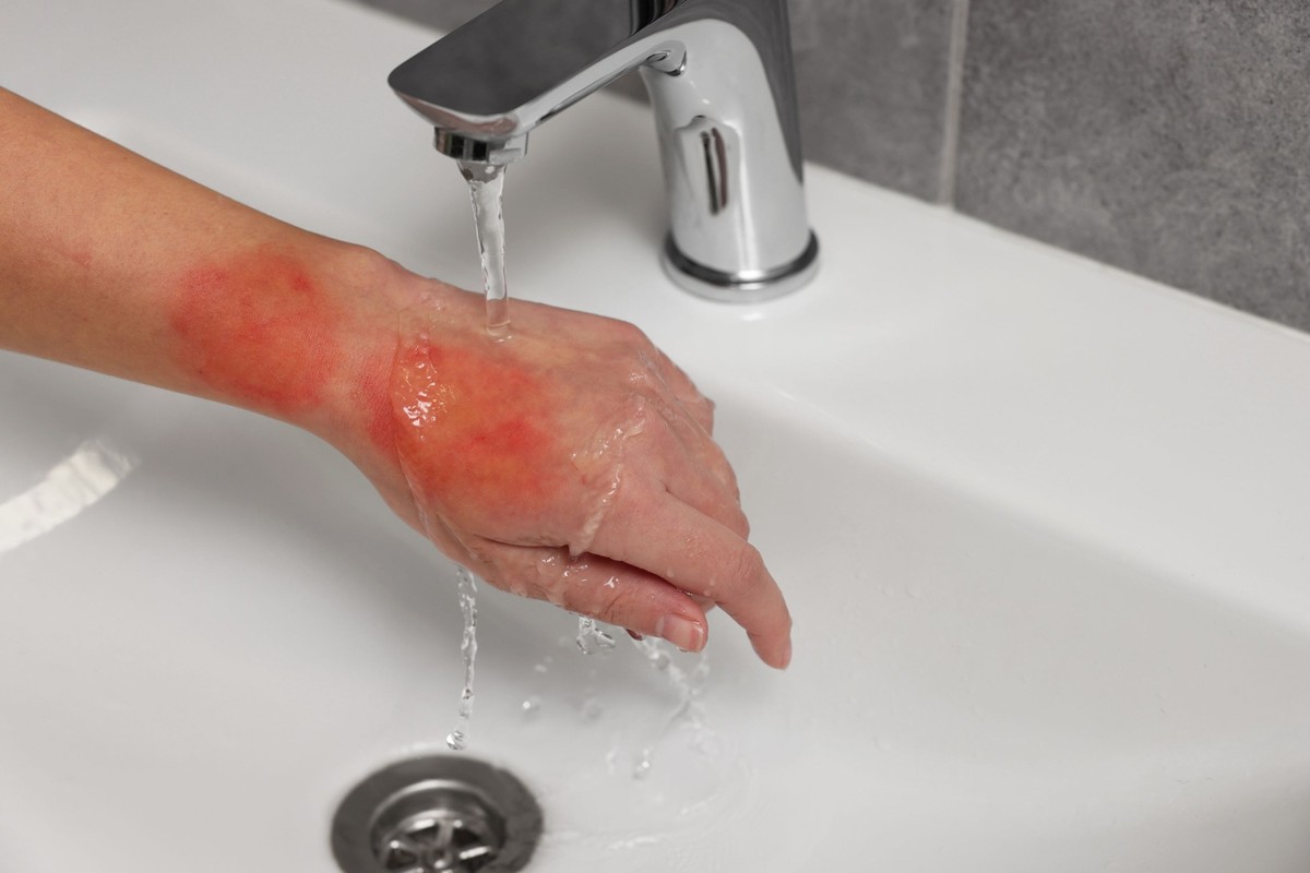Kaltes Wasser lindert definitiv den unangenehmen Verbrennungsschmerz.