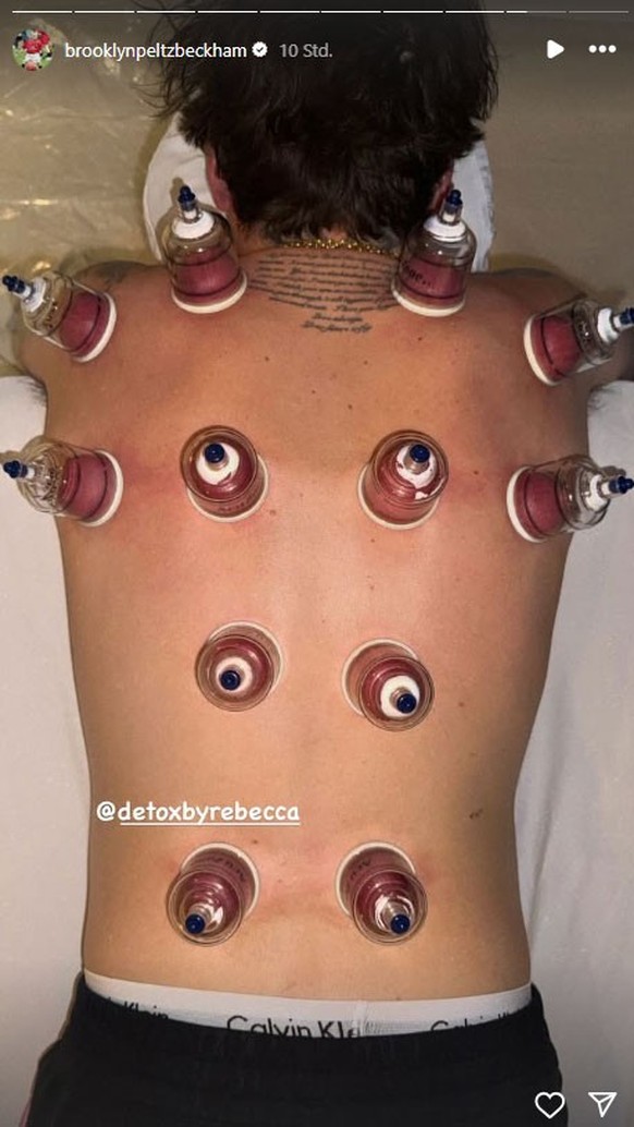 Brooklyn Beckham unterzieht sich einer Schröpftherapie.