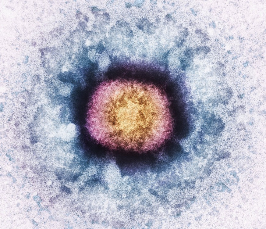 Eingefärbte Pockenviren im Elektronenmikroskop: Mehrere europäische Länder, inzwischen auch Deutschland, melden Infektionen mit Affenpocken. 