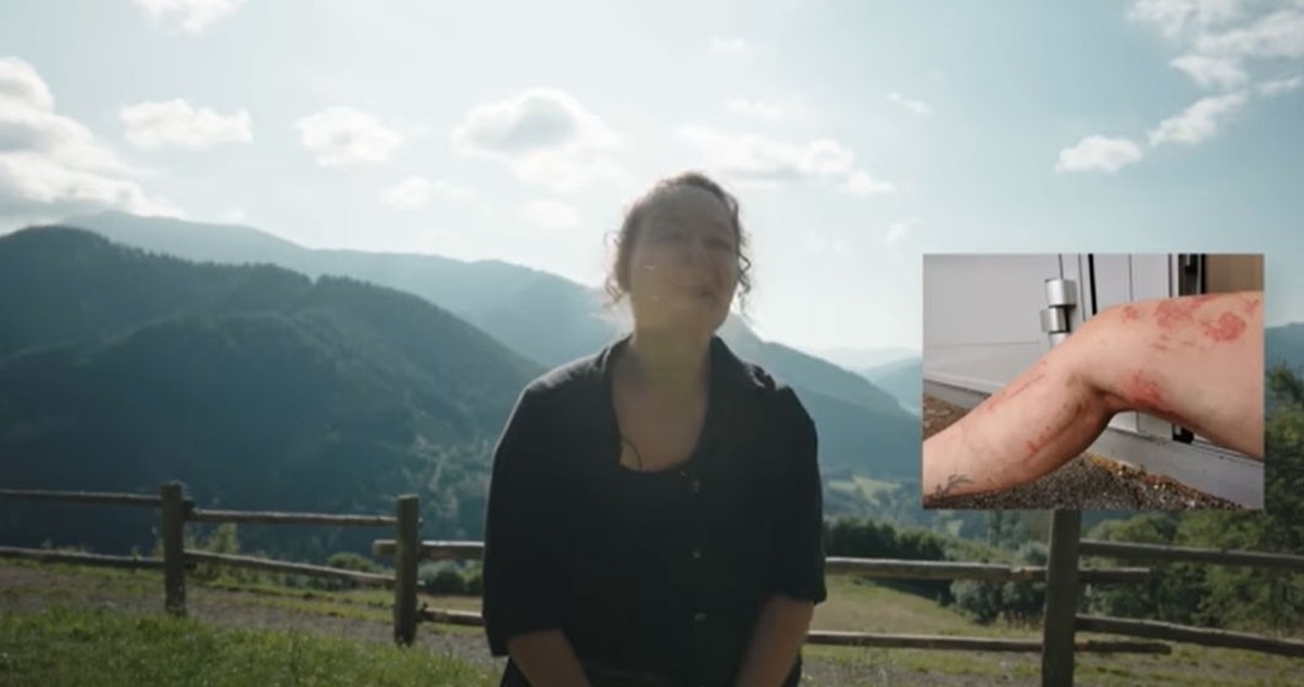 Hannah Assil zeigt ihr Bein kurz nach dem Unfall.