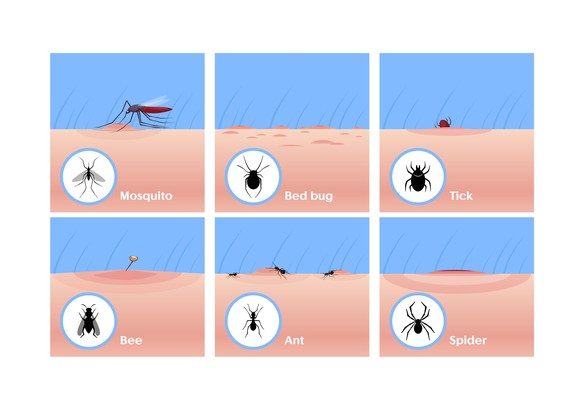 Insect bites flat vector illustrations set. Mosquito drinking blood, tick getting under skin, bee sting. Bed bug, ant and spider bites. Skin lesion, wound and inflammation, allergic reaction