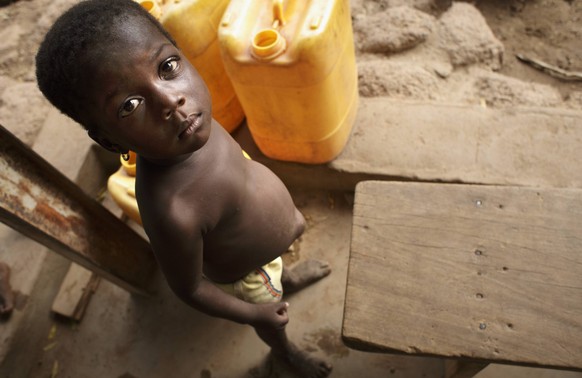 Kind mit Hungeroedem . FadaNgourma , Burkina Faso . A child with a hunger edema . FadaNgourma , Burkina Faso . 20.04.2008 , MODEL RELEASE vorhanden , MODEL RELEASED , FadaNgourma Burkina Faso PUBLICAT ...