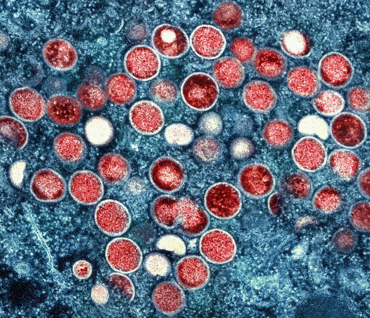 FILE - This undated image provided by the National Institute of Allergy and Infectious Diseases shows a colorized transmission electron micrograph of monkeypox particles (red) found within an infected ...