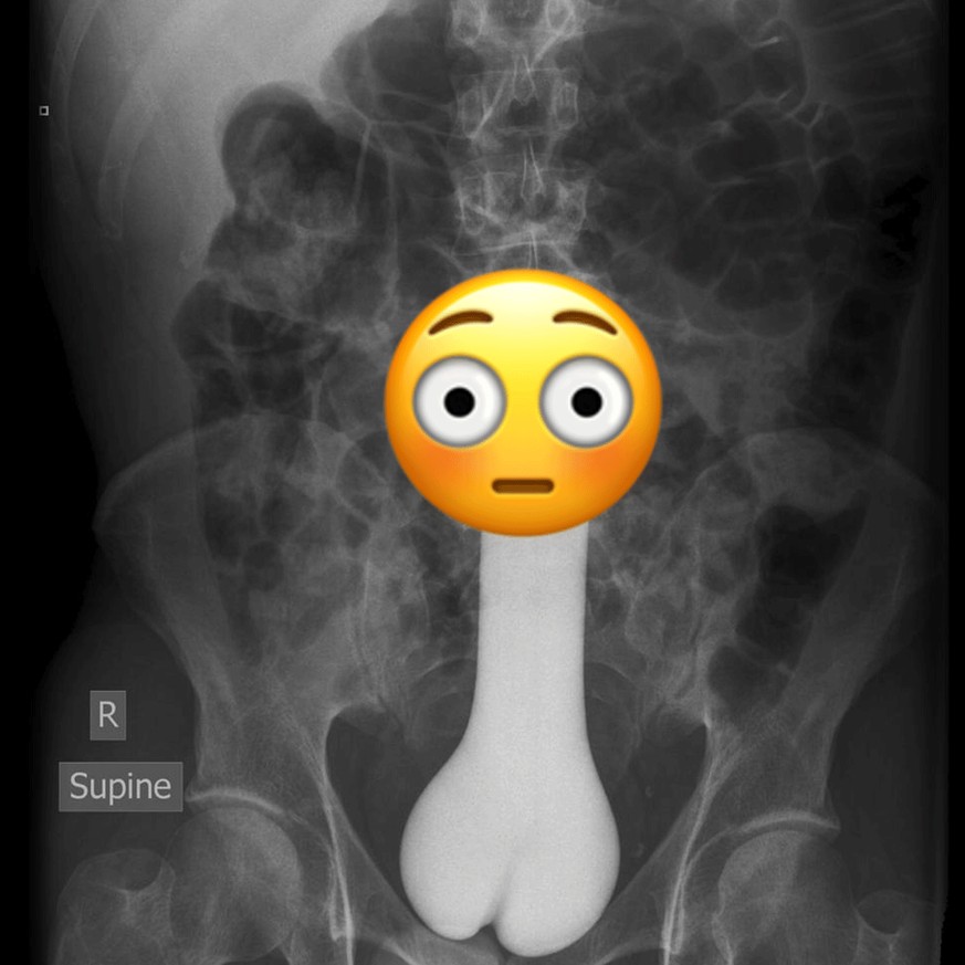 6 Dinge, die Ärzte schon aus den Hintern von Patienten entfernen mussten