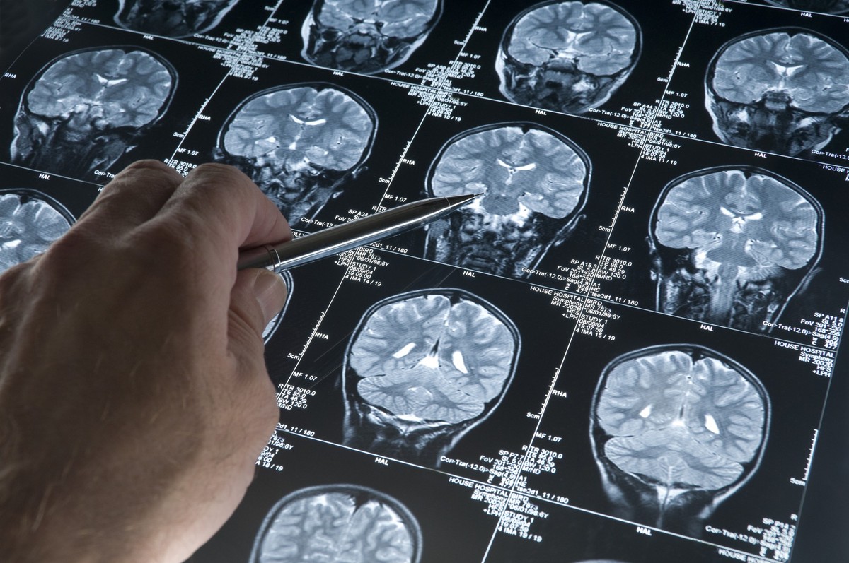 Seit 2013 gibt es in Kanada eine neurologische Krankheit, die viele Fragen aufwirft.