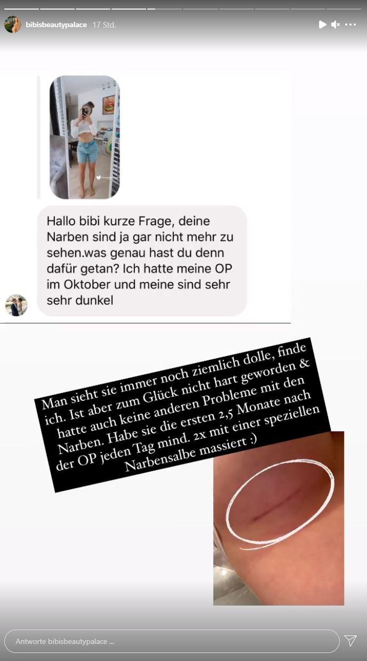 Bibi Claßen zeigte ihren Fans, wie sie Narbe an ihrer Brust mittlerweile aussieht.