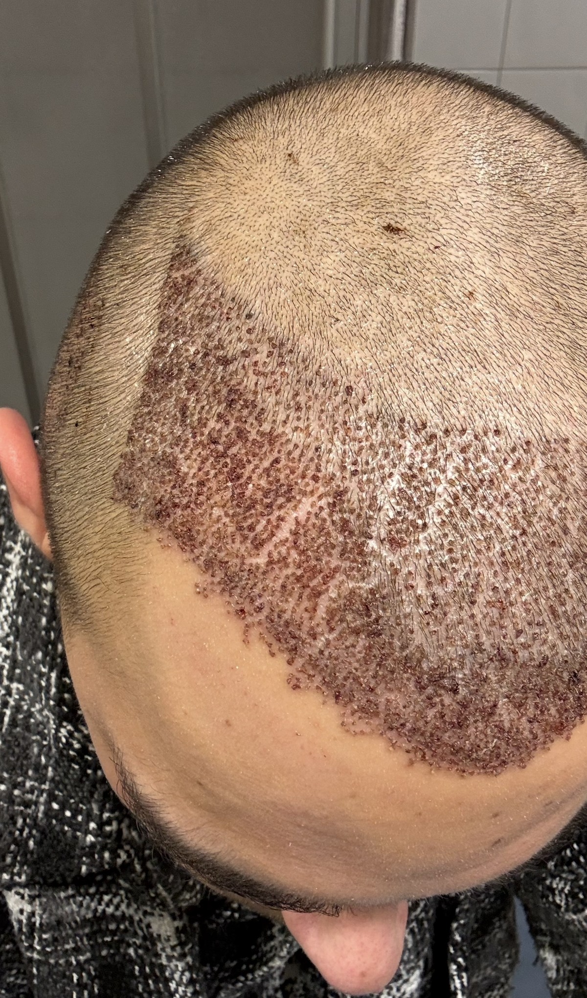 Haartransplantation Nico Rolle