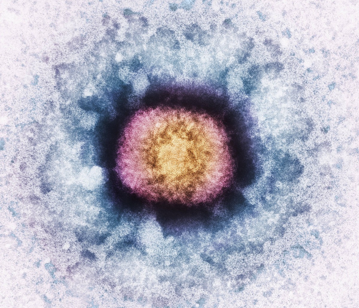 Vaccinia virus particle, TEM Vaccinia virus particle (VV), coloured transmission electron micrograph (TEM). VV is composed of a DNA (deoxyribonucleic acid) core (orange), surrounded by a protein coat ...