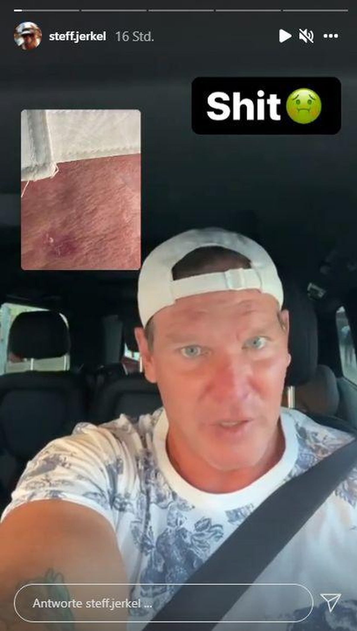 Steff Jerkel zeigt die betroffene Stelle an seiner Stirn.